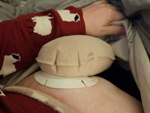 Managing ballooning for ostomates