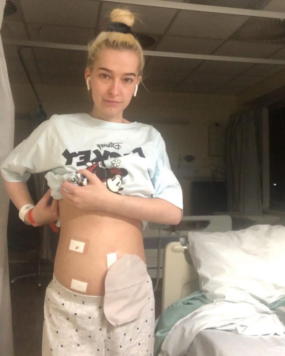 my sepsis story sepsis story with a stoma