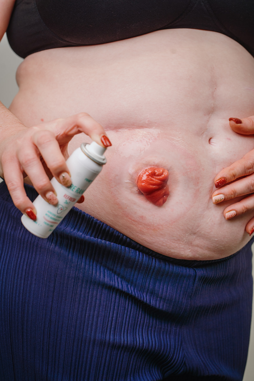 Refresh20_reduced-redness-v04-copy Refresh on stoma